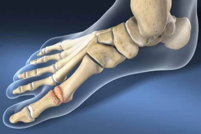 اصلاح هالوکس ریجیدوس: جراحی یا روش‌های غیرجراحی؟