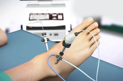 آرتروسکوپی مچ پا: روش‌های جدید برای درمان آسیب‌های لیگامانی جزئی