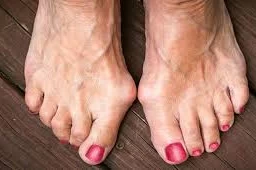 از اصلاح هالوکس والگوس با جراحی چه می‌دانید؟