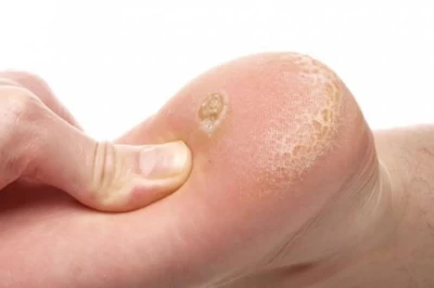 پاهایی که می‌درخشند: راهکارهای پیشگیری و درمان مشکلات شایع پا