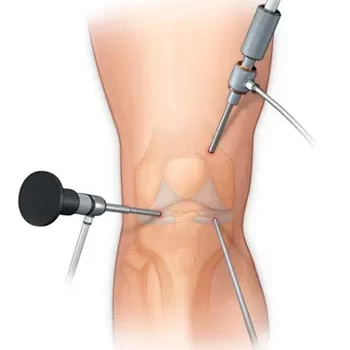 همه چیز درباره آرتروسکوپی زانو: تکنیکها و کاربردها
