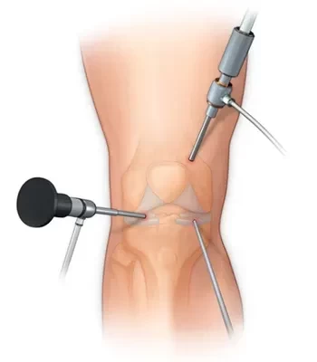 همه چیز درباره آرتروسکوپی زانو: تکنیکها و کاربردها