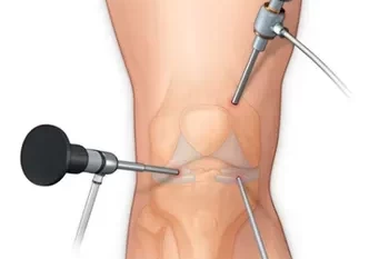 همه چیز درباره آرتروسکوپی زانو: تکنیکها و کاربردها