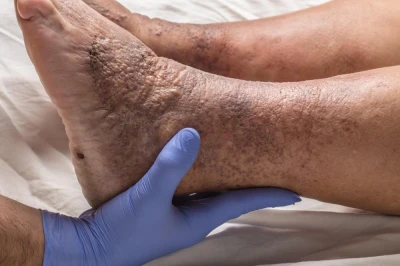 بررسی روش‌های جلوگیری از ترومبوز وریدی پس از آرتروپلاستی | پیشگیری و مراقبت پس از جراحی زانو