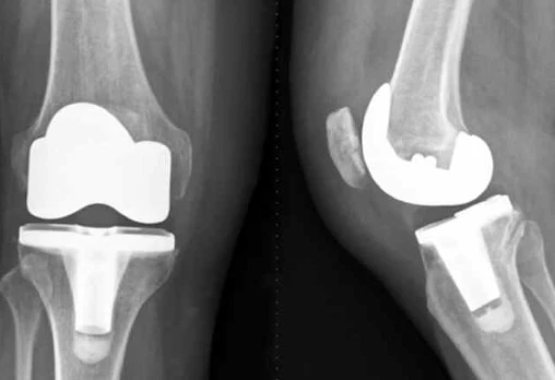 اهمیت تقارن در آرتروپلاستی دوطرفه زانو | بهبود عملکرد و کاهش عوارض