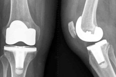 اهمیت تقارن در آرتروپلاستی دوطرفه زانو | بهبود عملکرد و کاهش عوارض