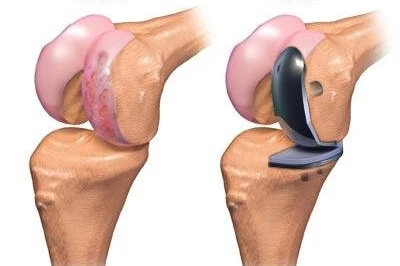 شکستگی پریکمپلانت در آرتروپلاستی زانو | مدیریت و پیشگیری از عوارض