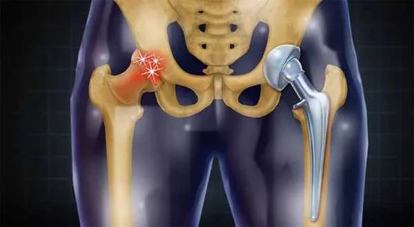 استفاده از Spacer در عفونت مفصل مصنوعی | درمان و بازسازی زانو