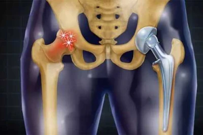 استفاده از Spacer در عفونت مفصل مصنوعی | درمان و بازسازی زانو