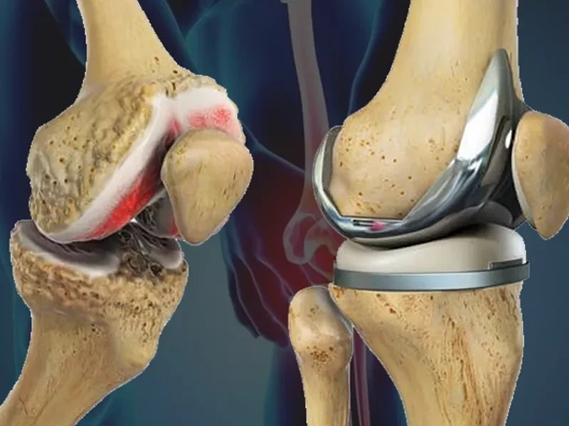 بازسازی مجدد (Revision) آرتروپلاستی زانو | چالش‌ها و نتایج