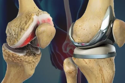 بازسازی مجدد (Revision) آرتروپلاستی زانو | چالش‌ها و نتایج