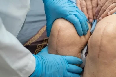 بررسی دلایل شل شدن زودرس ایمپلنت زانو | تحلیل عوامل مؤثر بر کاهش دوام پروتز مفصل زانو
