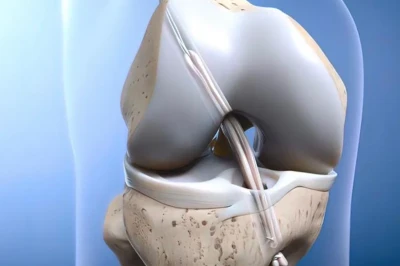 بازسازی مجدد رباط صلیبی قدامی (Revision ACL Reconstruction) | اصول جراحی و چالش‌های درمان ناپایداری زانو