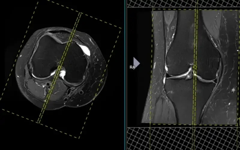 مقایسه MRI و آرتروسکوپی در تشخیص آسیب‌های منیسک | دقت تشخیص پارگی منیسک زانو