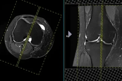 مقایسه MRI و آرتروسکوپی در تشخیص آسیب‌های منیسک | دقت تشخیص پارگی منیسک زانو
