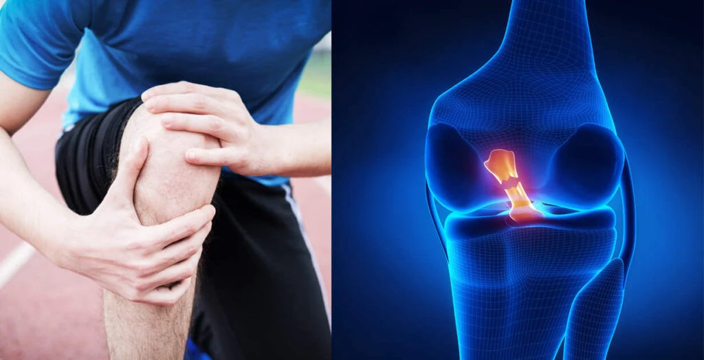 بررسی ارتباط بین ضعف همسترینگ و آسیب ACL | نقش عضلات پشت ران در پایداری زانو