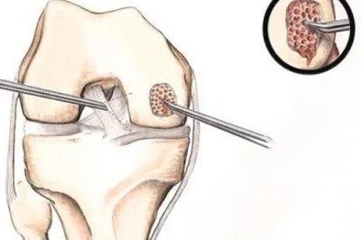 استفاده از Scaffold در بازسازی غضروف