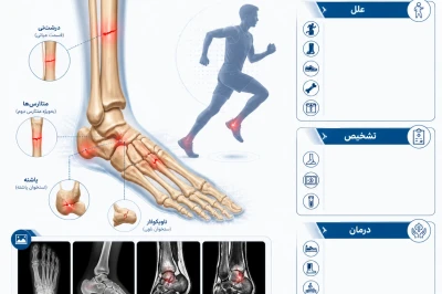 شکستگی‌های استرس پا در ورزشکاران | بررسی علل، تشخیص و روش‌های درمانی آسیب‌های ناشی از فشار مکرر