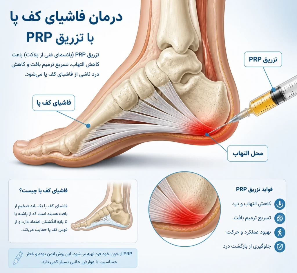 تزریق PRP در درمان فاسئیت پلانتار | روش نوین کاهش درد پاشنه پا