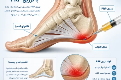 تزریق PRP در درمان فاسئیت پلانتار | روش نوین کاهش درد پاشنه پا