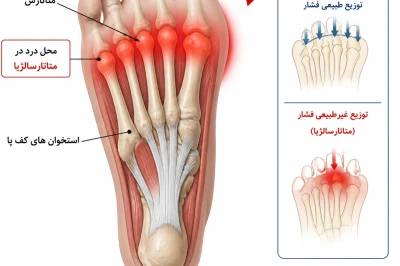 متاتارسالژیا و درد زیر پنجه پا | بررسی علل بیومکانیکی و درمان‌های پیشرفته
