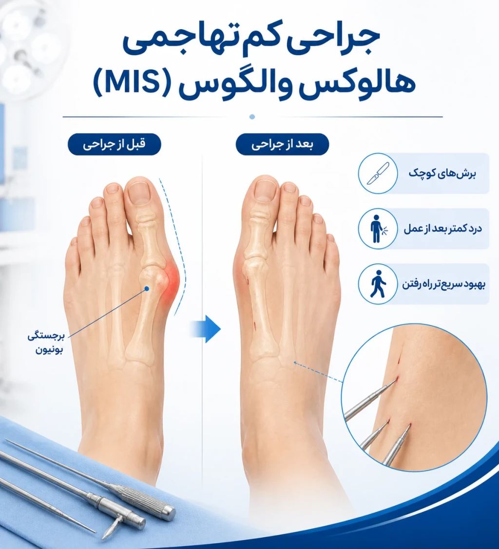 جراحی کم‌تهاجمی هالوکس والگوس (MIS) | درمان قطعی انحراف شست پا بدون بخیه