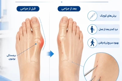 جراحی کم‌تهاجمی هالوکس والگوس (MIS) | درمان قطعی انحراف شست پا بدون بخیه