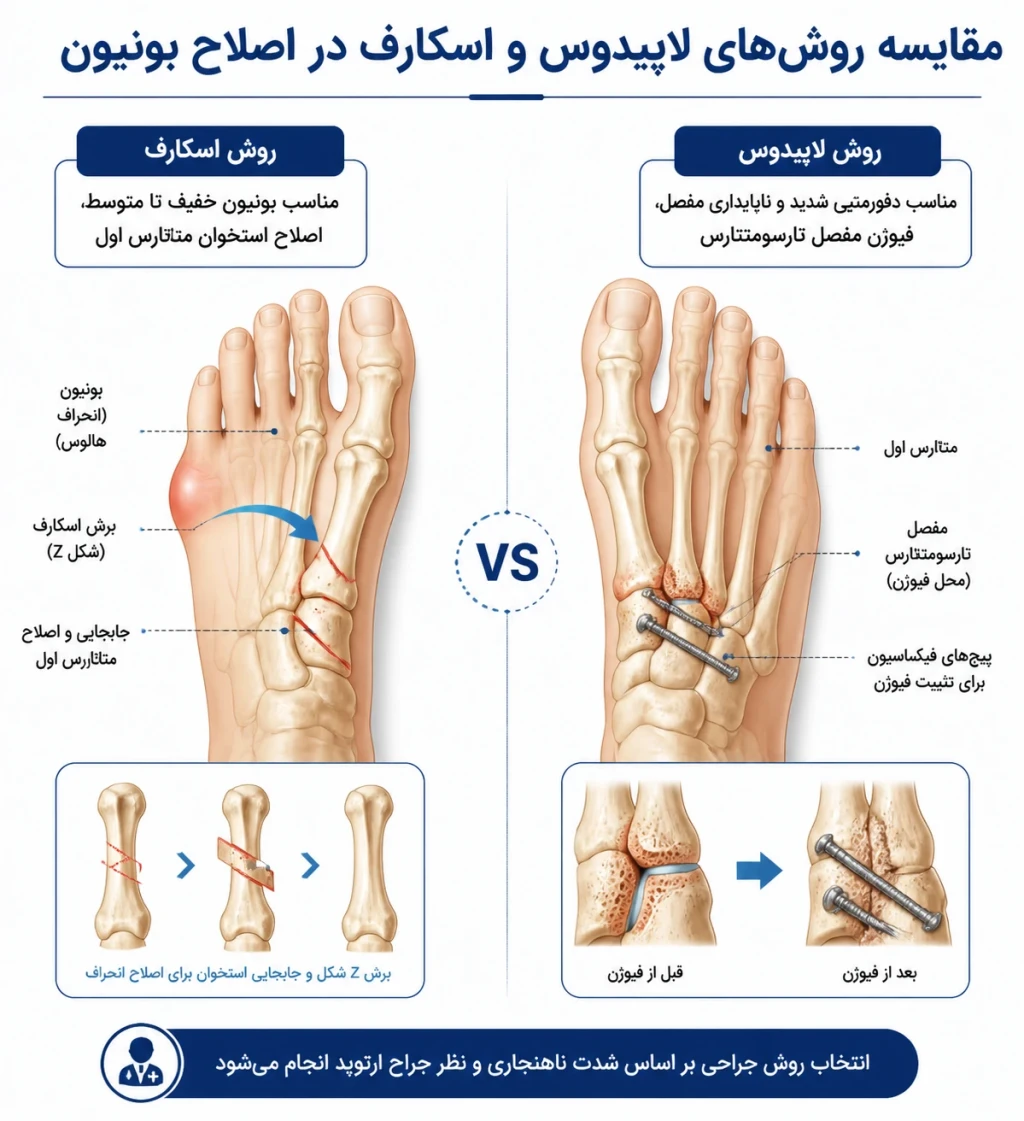 مقایسه روش‌های لاپیدوس و اسکارف در اصلاح بونیون | جراحی هالوکس والگوس
