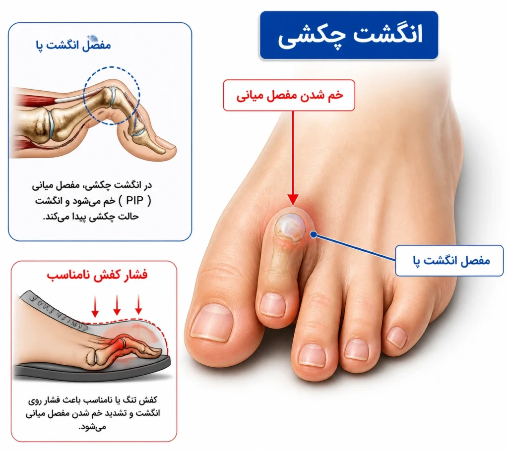 دفورمیتی انگشت چکشی (Hammer Toe) | بررسی روش‌های اصلاح و درمان