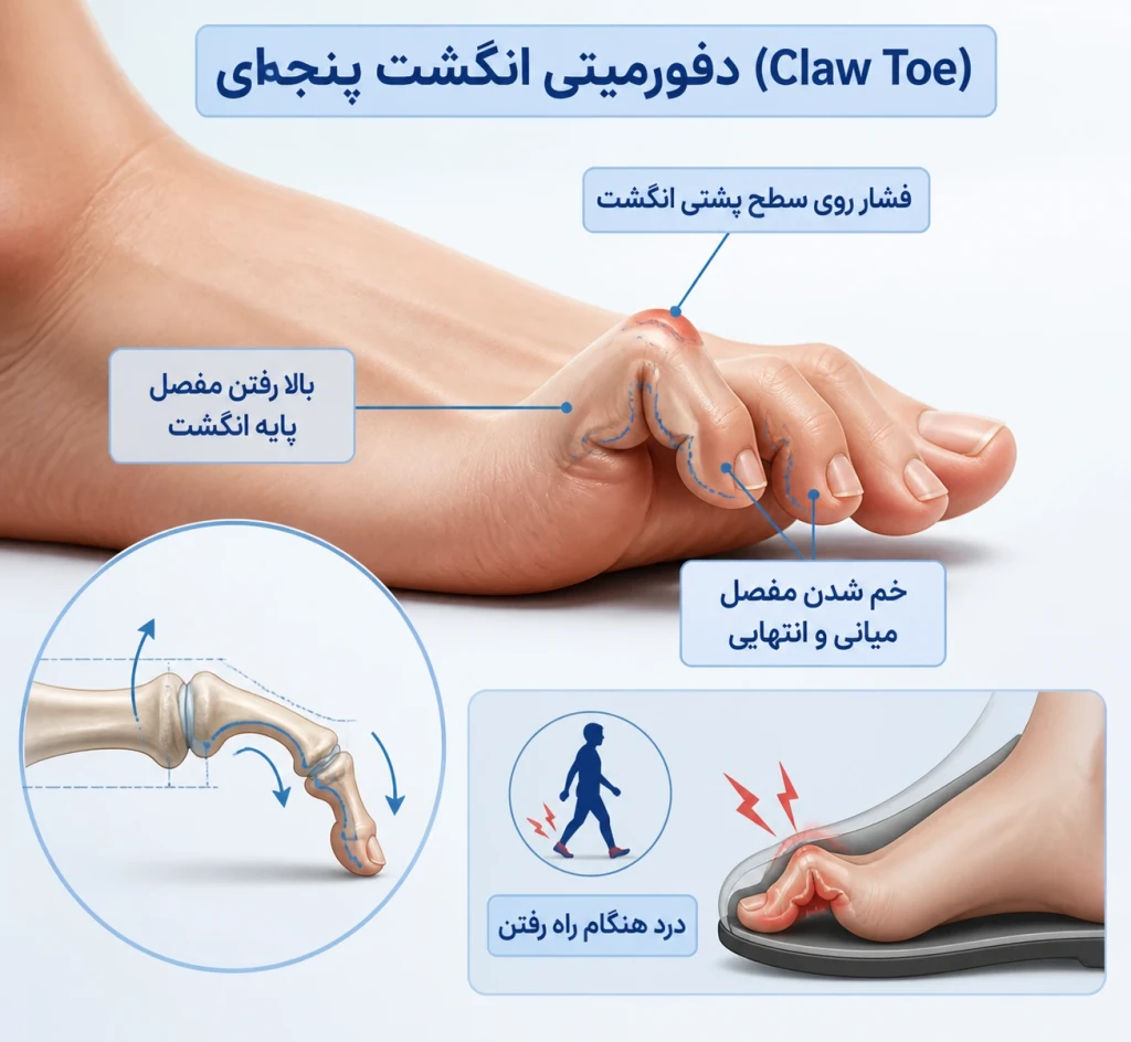 دفورمیتی انگشت پنجه‌ای (Claw Toe) | بررسی علت‌ها و روش‌های درمان