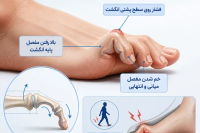 دفورمیتی انگشت پنجه‌ای (Claw Toe) | بررسی علت‌ها و روش‌های درمان