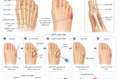 درمان جراحی انحراف انگشت کوچک پا | بررسی تخصصی Tailor’s Bunion
