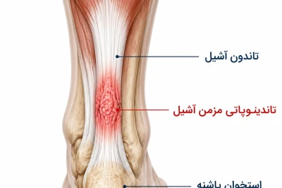 تاندینوپاتی مزمن آشیل: علل و درمان