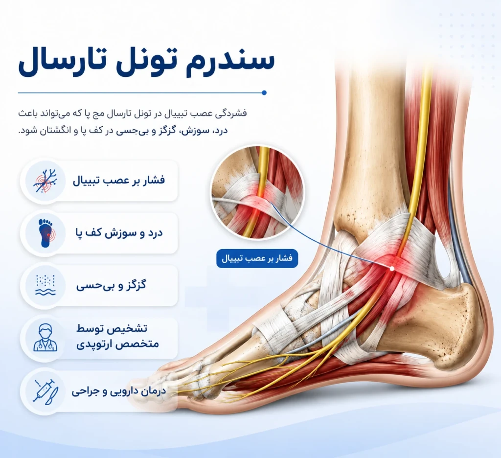 سندرم تونل تارسال: علائم، تشخیص و جراحی | بررسی فشار عصب مچ پا