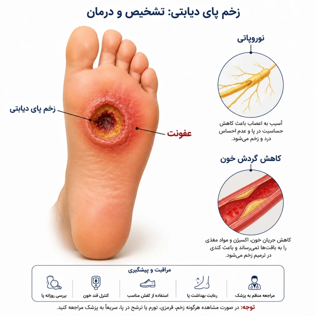 زخم پای دیابتی: اصول درمان و پیشگیری