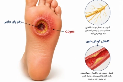زخم پای دیابتی: اصول درمان و پیشگیری