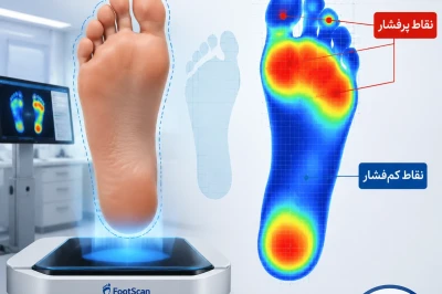 ارزیابی فشار کف پا در بیماران دیابتی