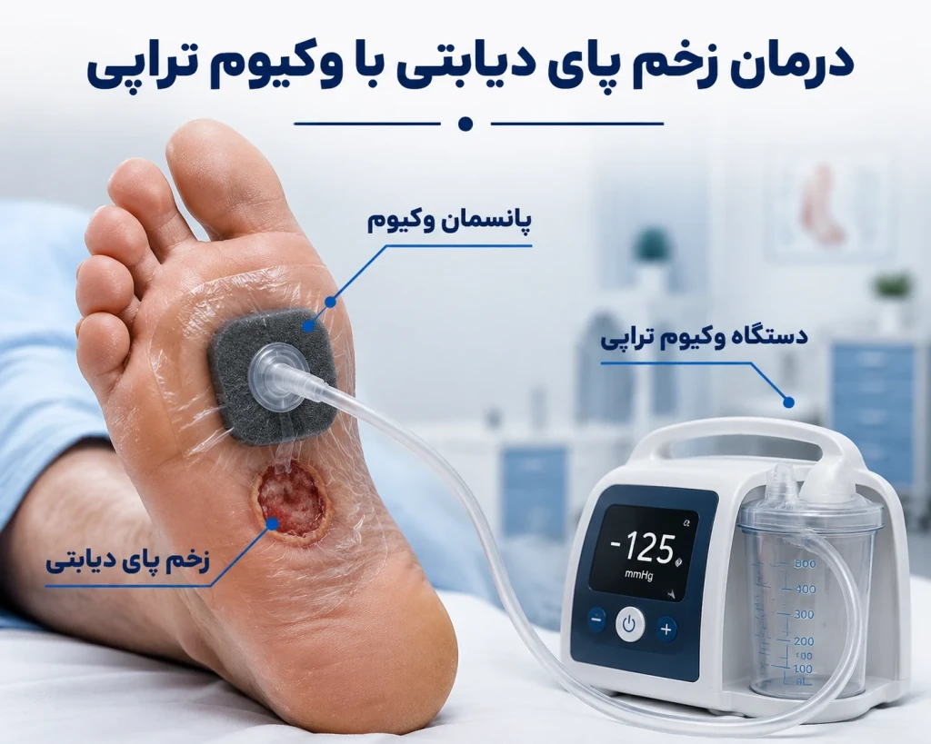 روش‌های نوین بستن زخم پای دیابتی با وکیوم تراپی