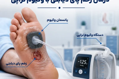 روش‌های نوین بستن زخم پای دیابتی با وکیوم تراپی
