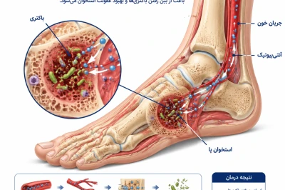 اصول آنتی‌بیوتیک‌تراپی در عفونت استخوانی پا