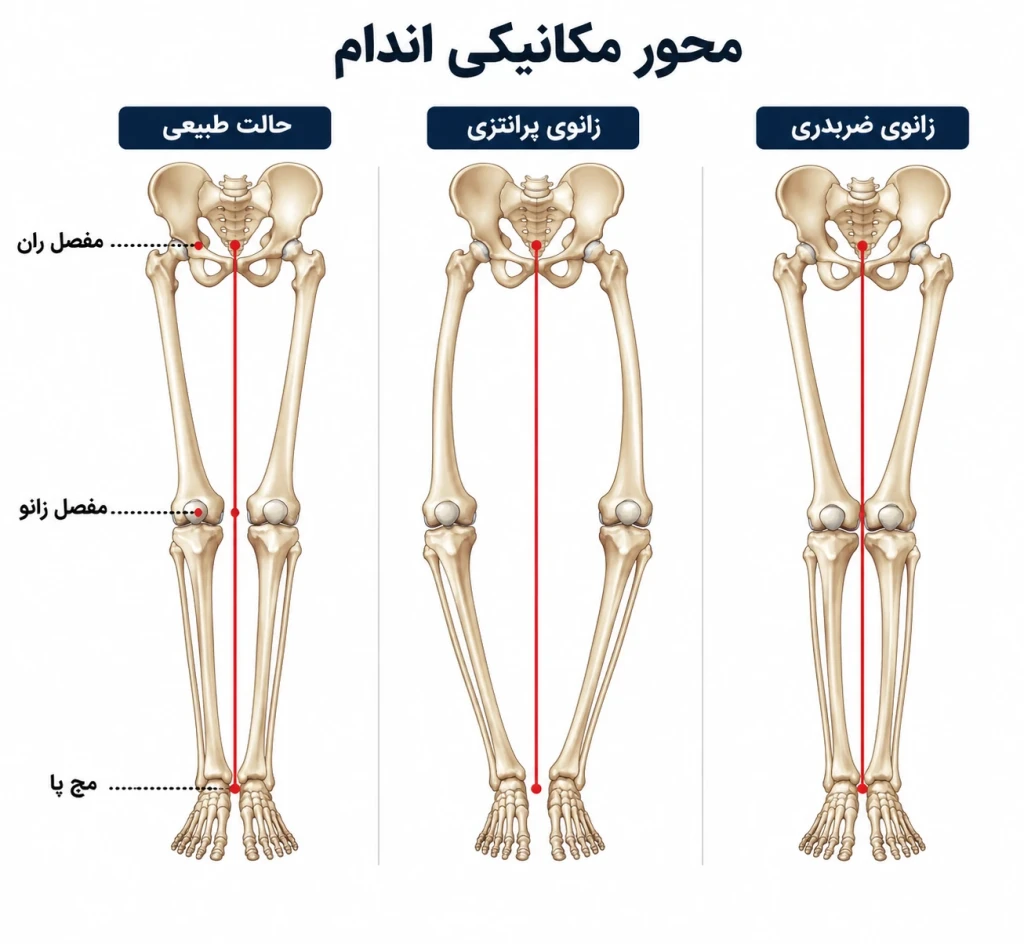 ارتباط دفورمیتی زانو و پا در محور مکانیکی اندام | بررسی تأثیر ناهنجاری‌های اندام تحتانی بر تعادل حرکتی