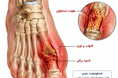 استئومیلیت مزمن پا: درمان مرحله‌ای و جراحی