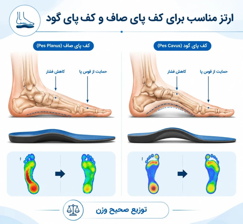انتخاب ارتز مناسب در بیماران با فلت‌فوت یا کاووس فوت | راهنمای تخصصی حمایت از قوس پا