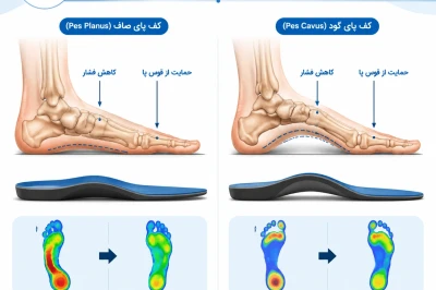 انتخاب ارتز مناسب در بیماران با فلت‌فوت یا کاووس فوت | راهنمای تخصصی حمایت از قوس پا
