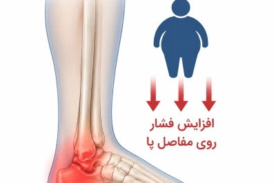 بررسی اثر وزن بالا بر دردهای پا و مچ پا