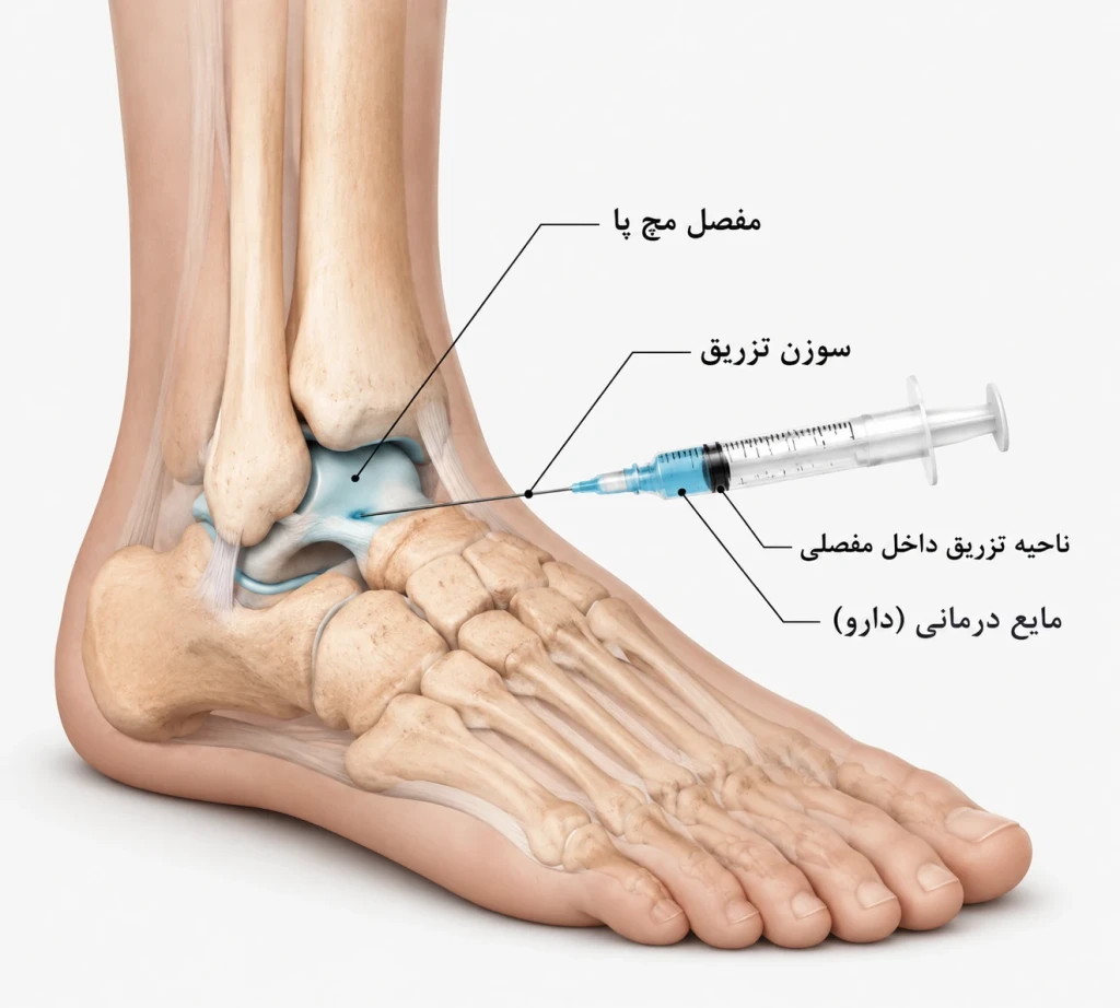 روش‌های تزریق داخل‌مفصلی در مچ پا | بررسی کاربردها، مزایا و نتایج درمانی