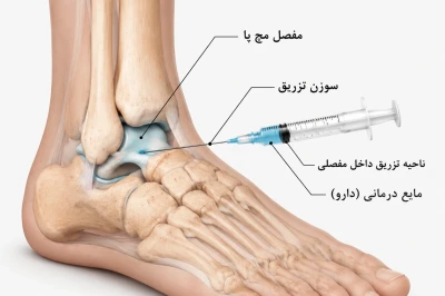 روش‌های تزریق داخل‌مفصلی در مچ پا | بررسی کاربردها، مزایا و نتایج درمانی