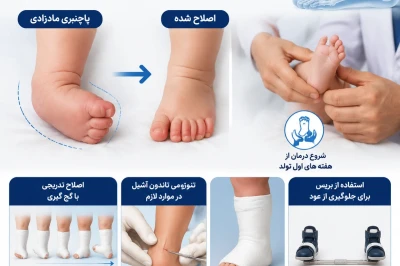 درمان پاچنبری (Clubfoot) با روش پونستی | اصلاح ناهنجاری مادرزادی پا