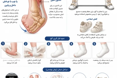 پیگیری طولانی‌مدت بیماران مبتلا به کلاب فوت | اهمیت درمان مداوم و اصلاح پای چنبری
