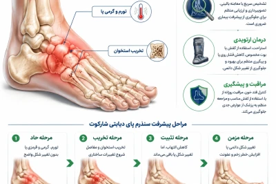 سندرم پای دیابتی شارکوت | بررسی مراحل و روش‌های نوین درمان